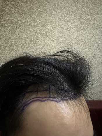 수술전