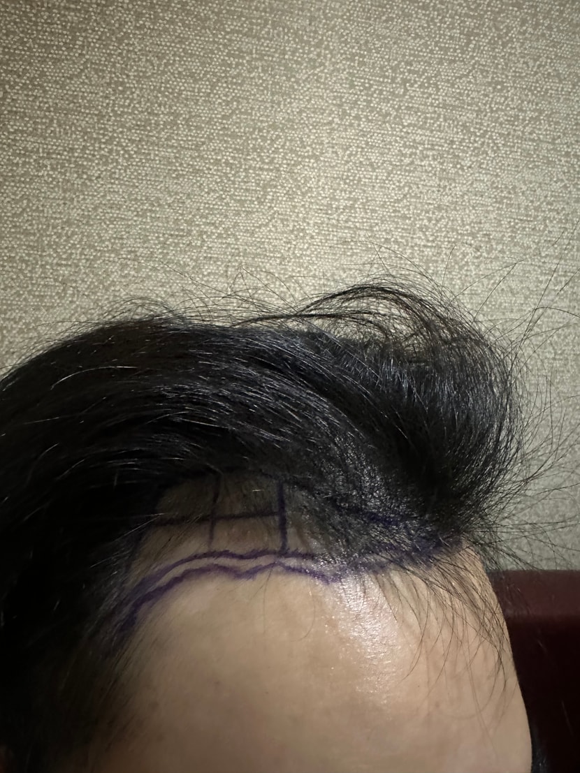 수술전