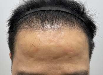 수술후