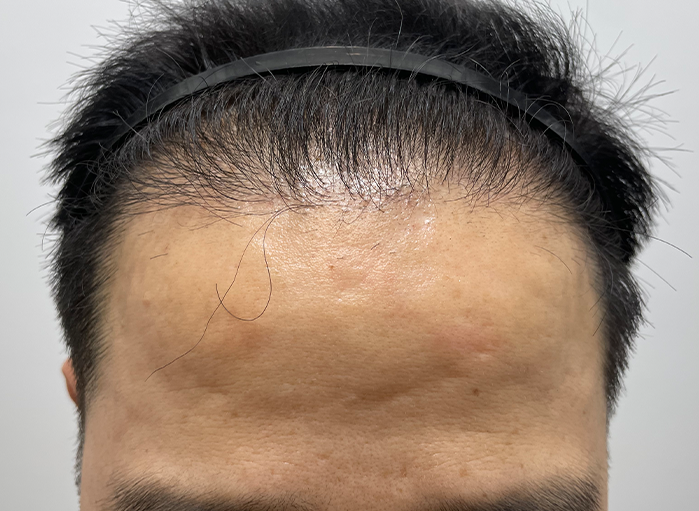수술후