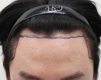 수술전 디자인