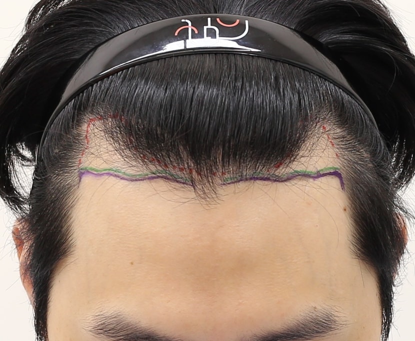 수술전