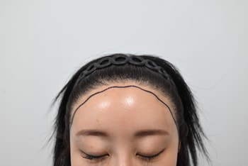 수술전