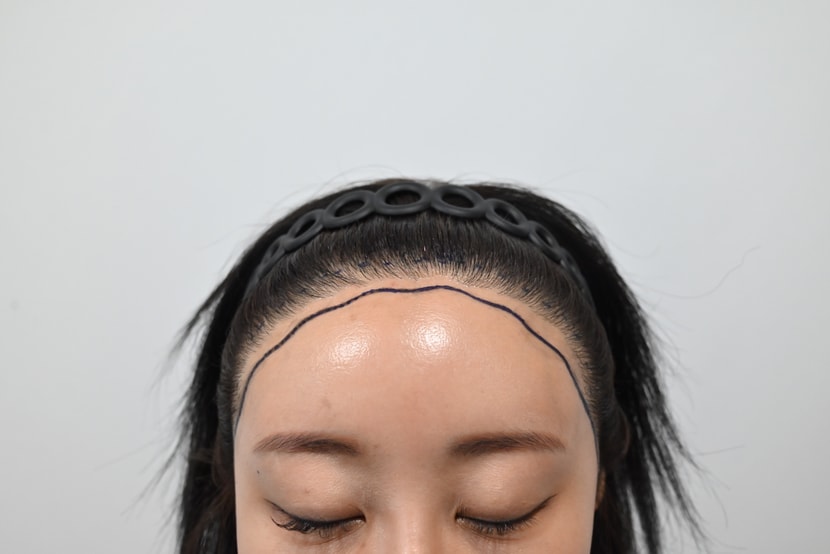 수술전