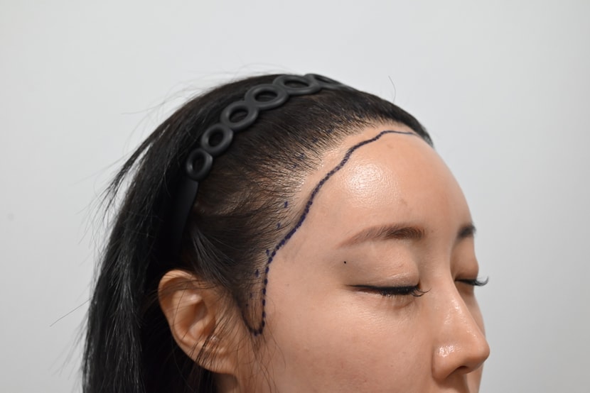 수술전