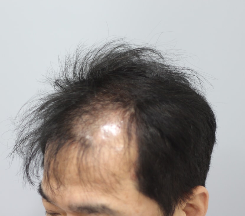 모발이식 전