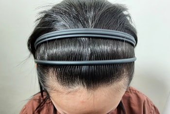수술전