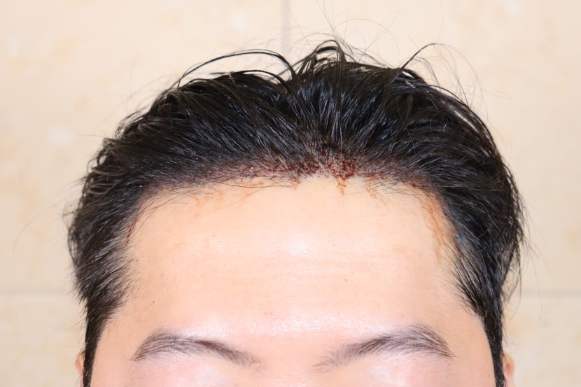수술후
