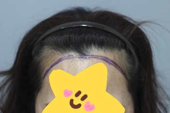 헤어라인모발이식 전