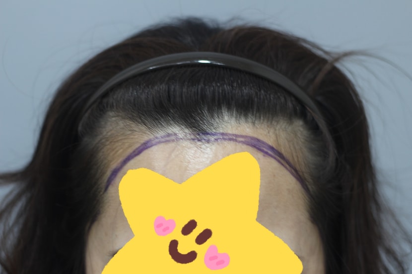 헤어라인모발이식 전