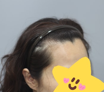 헤어라인모발이식 전
