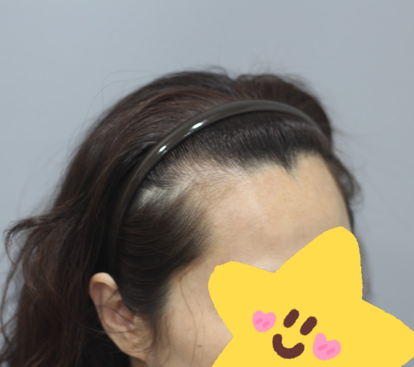 헤어라인모발이식 전