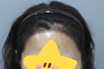 헤어라인모발이식 후