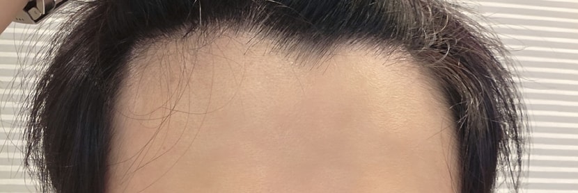 모발이식 전
