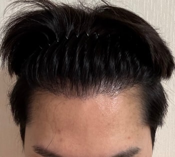 수술후(위)