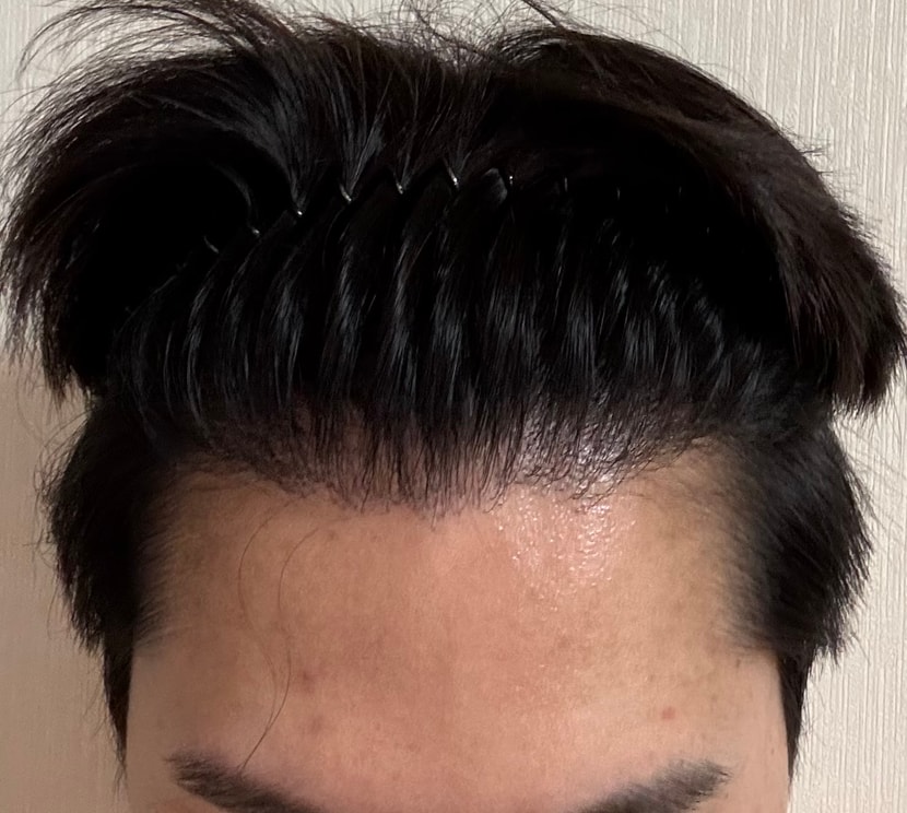 수술후(위)