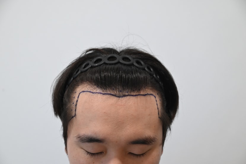 수술전