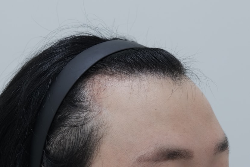수술전