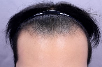 수술전