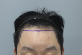 헤어라인모발이식 전