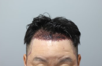 헤어라인모발이식 후