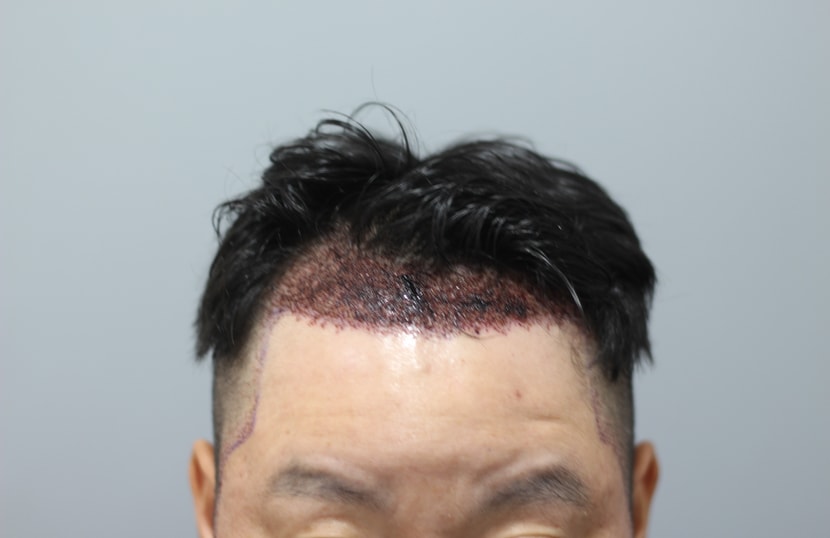 헤어라인모발이식 후