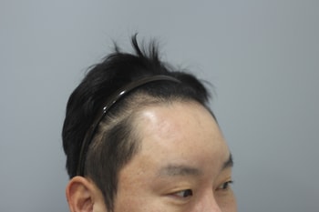 헤어라인모발이식 전