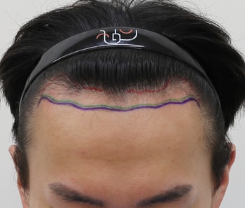 수술 전