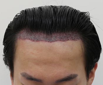 수술 후