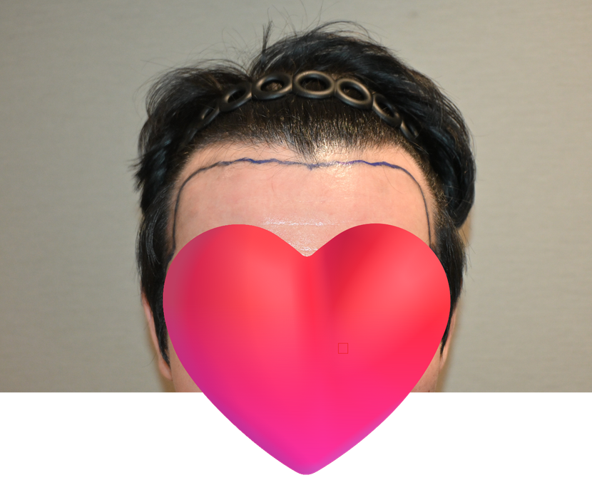수술전