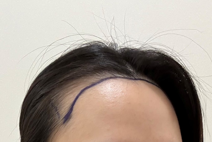 수술 당일 디자인