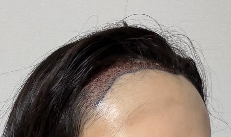 이식 후 (2).jpg
