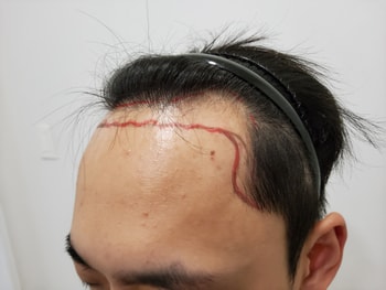 시술 전
