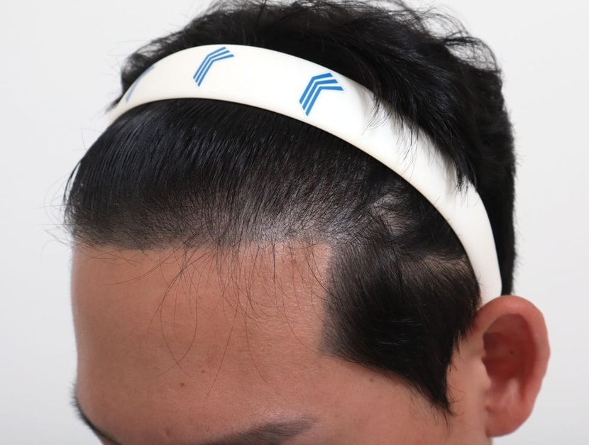 수술전 (두피문신)