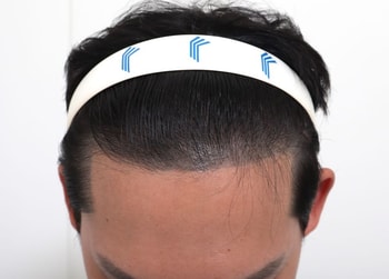 수술전 (두피문신)