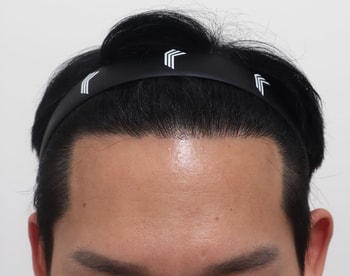 모발이식 후