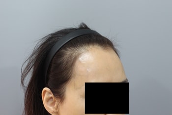 모발이식 수술 전