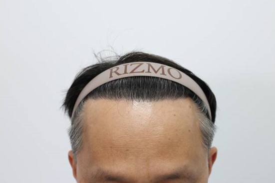 모발 이식 후 사진