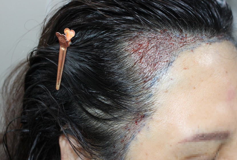 수술당일