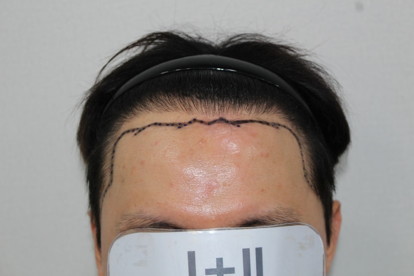 수술전