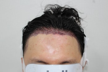 수술후