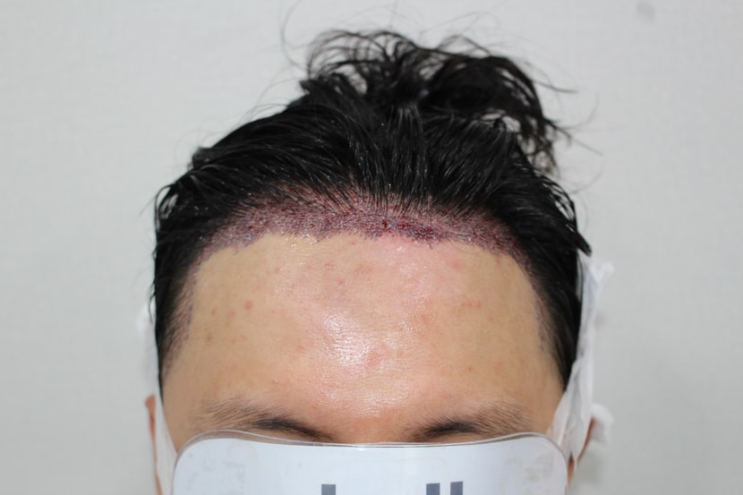 수술후