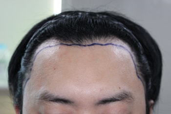 수술전