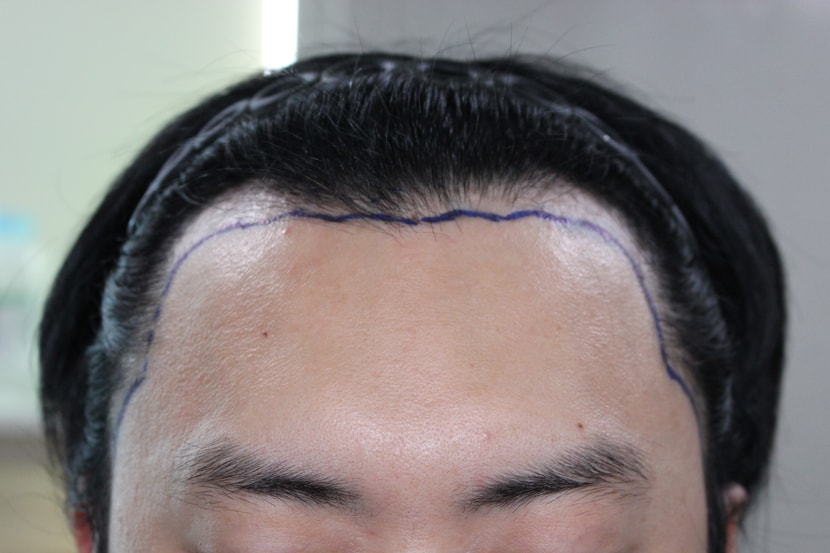 수술전
