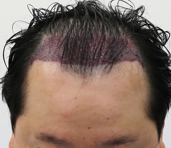 수술 후