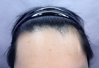 수술전