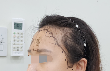 수술전디자인