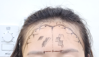 수술전디자인