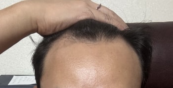 수술전엠자 ㅋ