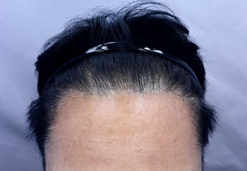 수술전